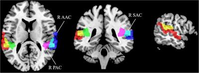 Lateralization of cerebral blood flow in the auditory cortex of patients with idiopathic tinnitus and healthy controls: An arterial spin labeling study